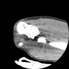 SPORK, NICO - 22.03.1976 - 02.08.2022 - CT obere Extremität - 17:51:17